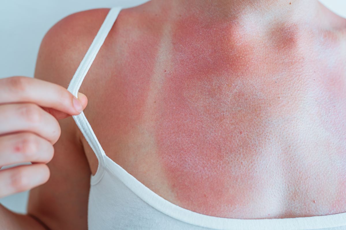 Sonnenbrand vermeiden, behandeln und ernst nehmen – Tipps fü